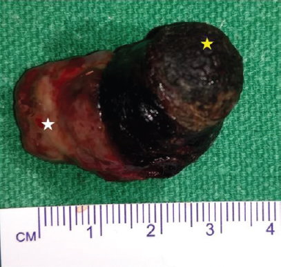 Specimen of excised nasal mass showing intranasal vascular mucosa (white star) and external necrosed part of mass (yellow star).